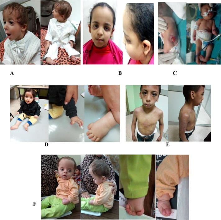Congenital Malformations