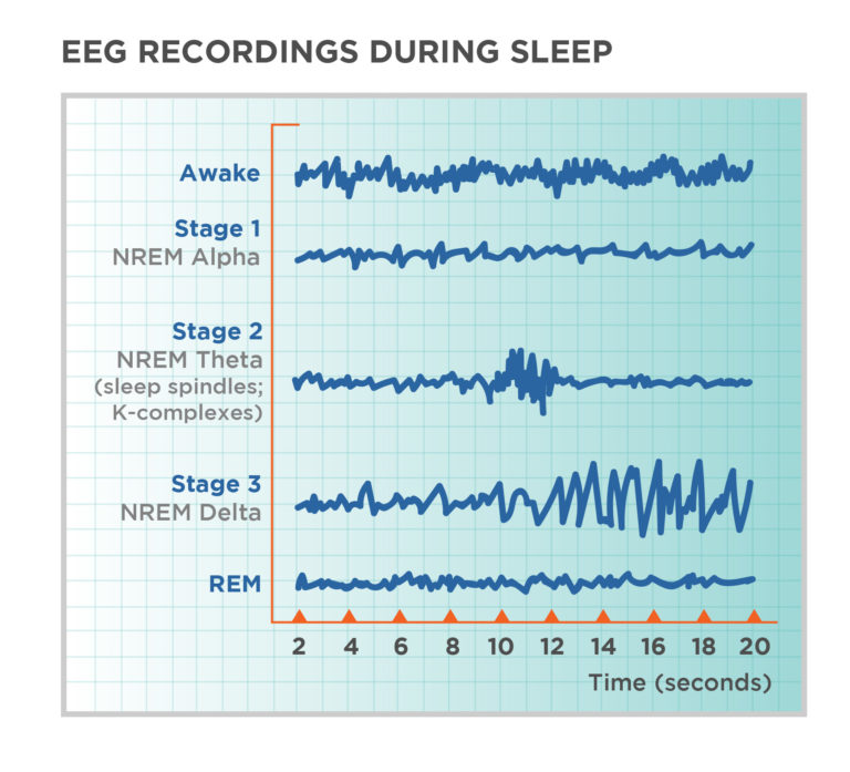 Figure 2.2: EEG recordings showing Awake, N1, N2, N3, and REM brain wave patterns