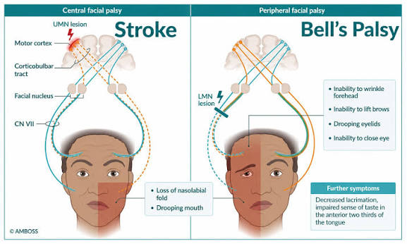 Figure 3: Facial palsy differences between Bell's palsy (LMN) and Stroke (UMN)