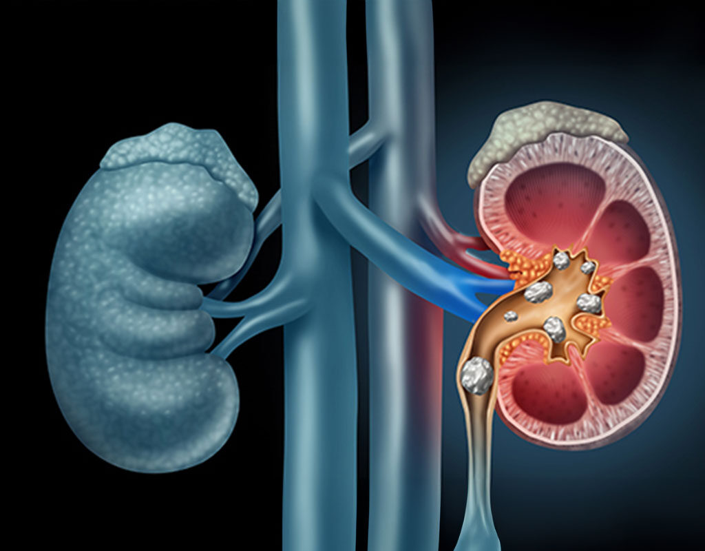 Obstruction, Renal failure, Renal stones, UTIs