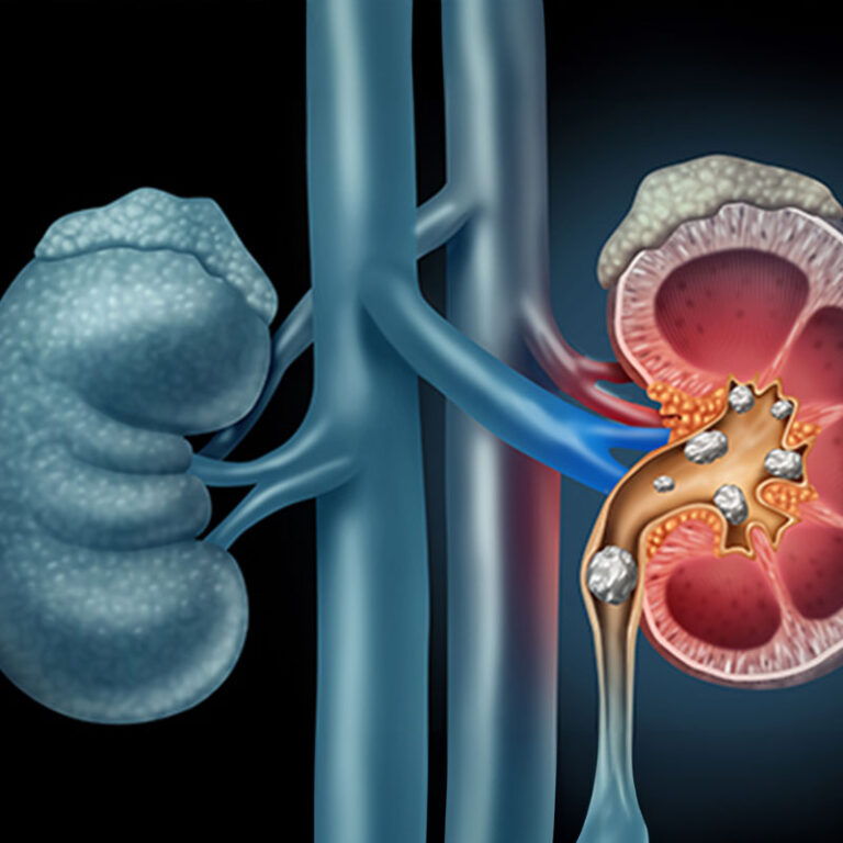 Obstruction, Renal failure, Renal stones, UTIs