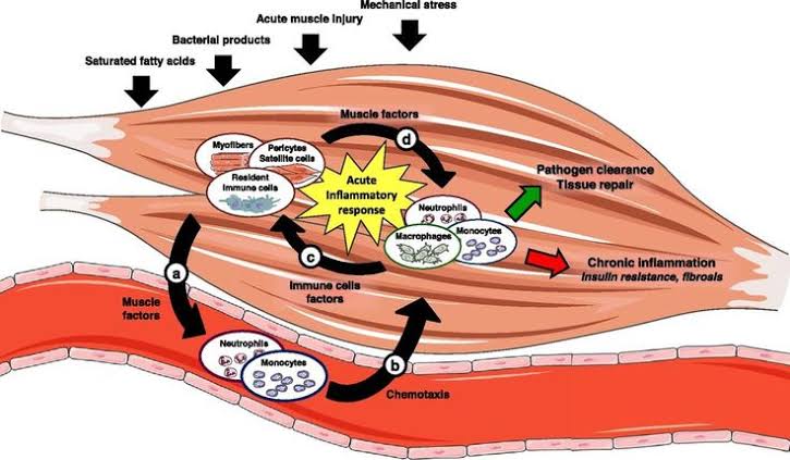 Figure 1: Pathophysiology of inflammatory myositis showing mechanical stress, bacterial products, and neutrophil infiltration