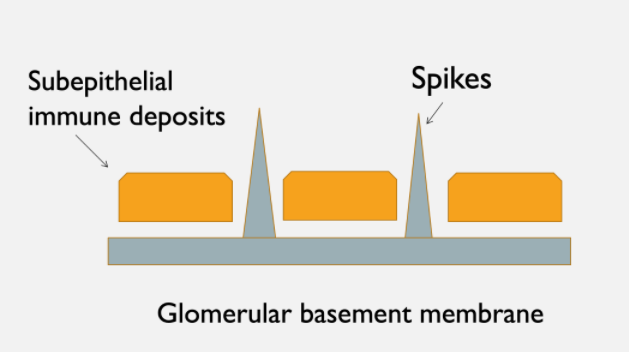 Figure 3. Membranous nephropathy showing subepithelial immune complex deposits with 'spike' formation