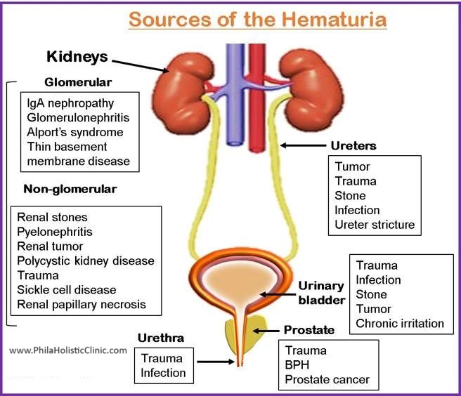 Figure 6. Sources of hematuria by anatomic location in the urinary system