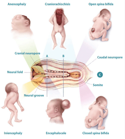 Figure 3. Types of neural tube defects including anencephaly, craniorachischisis, open spina bifida, iniencephaly, encephalocele, and closed spina bifida.