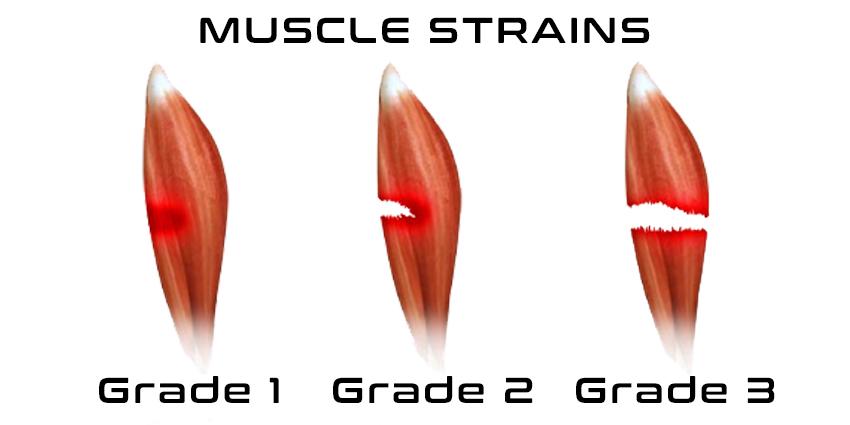 Figure 2: Visual representation of Grade 1, 2, and 3 muscle strains