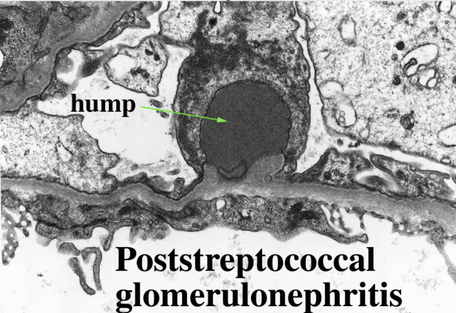 Figure 2. Pathology of acute post-streptococcal glomerulonephritis showing subepithelial humps