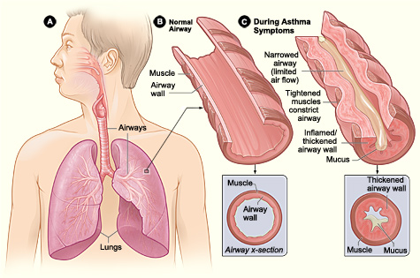 Figure: Asthma Pathophysiology — Comparison of a normal airway with an inflamed, constricted airway showing mucus and muscle tightening.