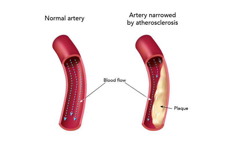 Figure 4: Atherosclerosis diagram showing normal blood flow vs. abnormal flow with plaque narrowing the artery