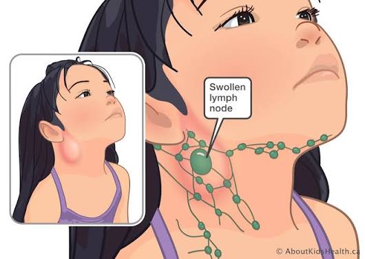 Figure: Cervical Lymphadenitis — Swollen Lymph Node in the Neck