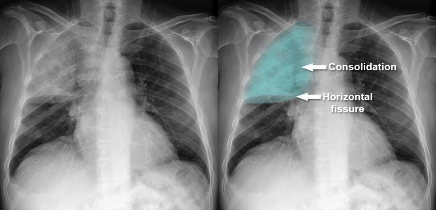 Figure: Chest X-Ray showing Lobar Consolidation in the right upper lobe, characteristic of Pneumococcal Pneumonia.