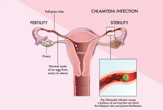Chlamydial Infections