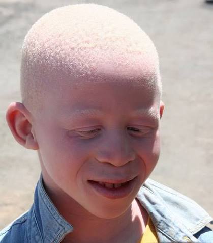 Common disorders of the skin (Albinism, Burns, Tumors)