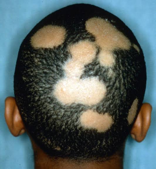 Common disorders of the skin and its appendages (Psoriasis, Acne, Alopecia)