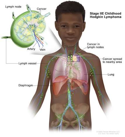 Disorders of Lymphatic system (Lymphadenitis, Hodgkin’s disease)
