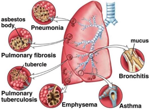 Disorders of the respiratory system (Asthma, Pneumonia, Emphysema)