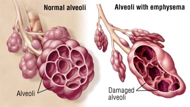 Figure: Emphysema Pathophysiology — Diagram showing the destruction of alveolar walls and loss of elastic tissue compared to normal lung tissue.