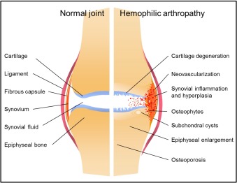 Figure: Hemophilic arthropathy: comparison of healthy knee joint versus joint with recurrent bleeding (hemarthrosis)