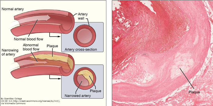 Figure 3: Normal artery vs. narrowed artery with plaque and histological section showing atherosclerosis