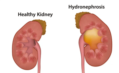 Obstruction, Renal failure, Renal stones, UTIs
