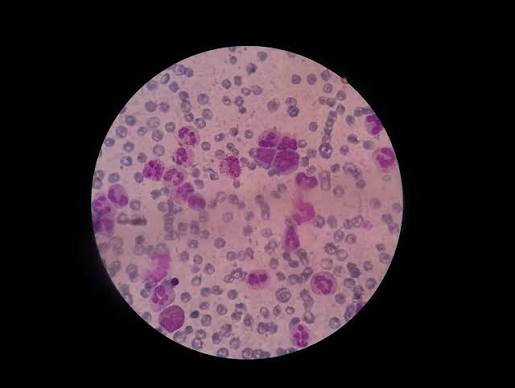 Figure: Peripheral blood smear from a patient with leukemia showing blast cells with high nuclear-to-cytoplasmic ratio