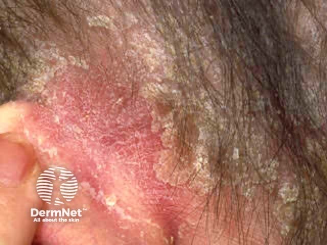 Figure 1: Severe scalp psoriasis demonstrating well-demarcated erythematous plaques with thick silvery-white scale