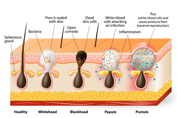 Figure 2: Types of acne vulgaris including comedones, papules, pustules, nodules, and cysts