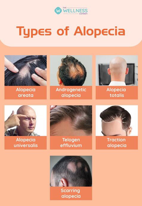 Figure 3: Visual guide to types of alopecia: Areata, Totalis, Universalis, Androgenetic, and Traction