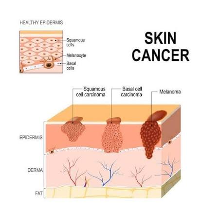 Figure 3: Types of skin cancer. Basal cell carcinoma, squamous cell carcinoma, and melanoma with their depths of invasion.