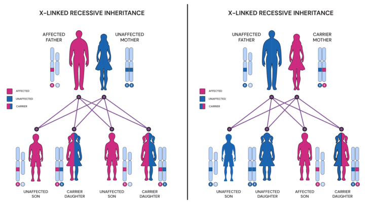 Figure: X-linked recessive inheritance pattern in hemophilia: carrier females transmit gene to 50% of sons and 50% of daughters