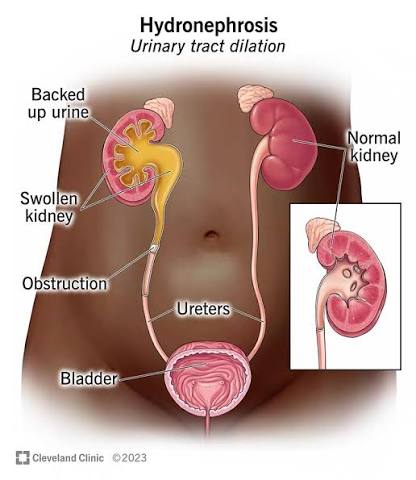 Figure 1: Illustration of hydronephrosis and urinary tract dilation due to obstruction