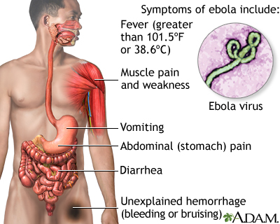 ebola