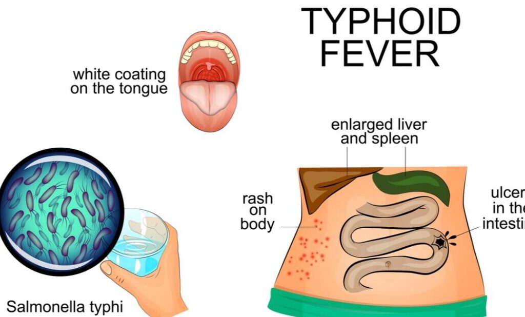 enteric fever