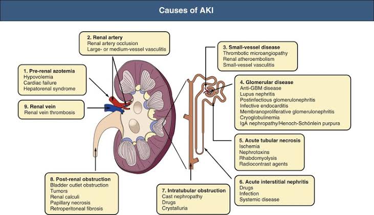 Figure 2: Anatomical map of the causes of AKI: Pre-renal, Intrinsic, and Post-renal