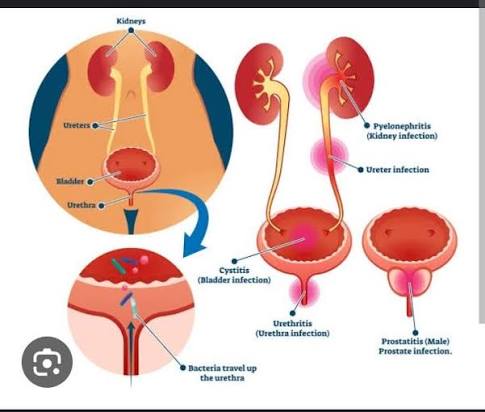 Figure 4: Anatomy of UTI: Cystitis, Ureteritis, Pyelonephritis, and Prostatitis