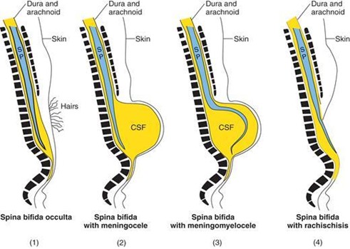 Schematic drawings illustrating the various types of spina bifida