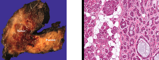 Adenoid Cystic Carcinoma