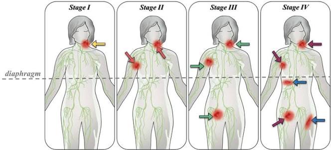 Ann Arbor staging system for lymphomas illustrating anatomical progression