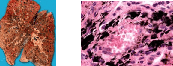 Anthracosis in human lung gross pathology and histopathology