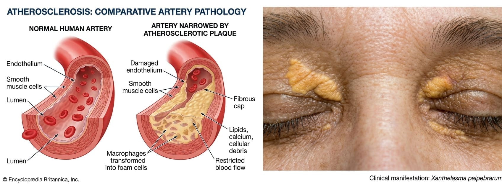 Atherosclerosis and Xanthelasma in Familial Hypercholesterolemia