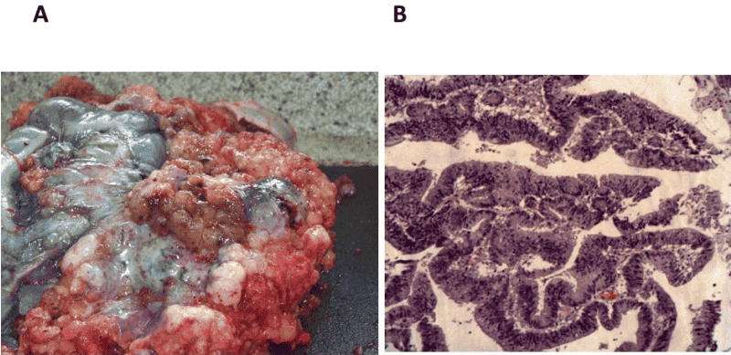 Autopsy gross specimen showing mucinous colon carcinoma and corresponding tissue histology