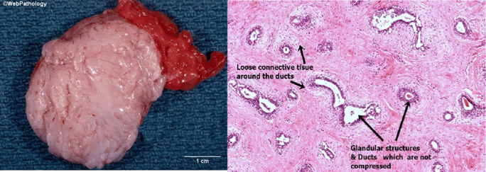 Breast fibroadenoma gross and microscopic appearance