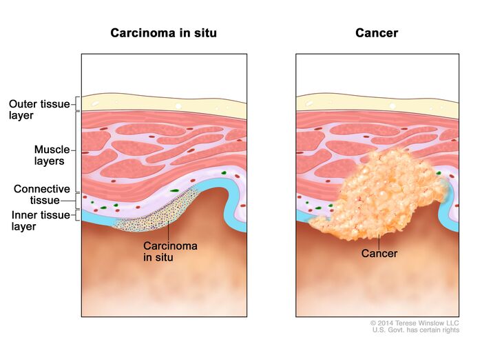 Carcinoma in situ versus invasive cancer comparison