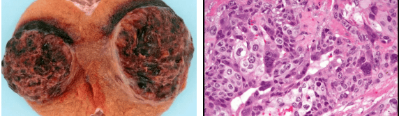 Choriocarcinoma Gross and Histology