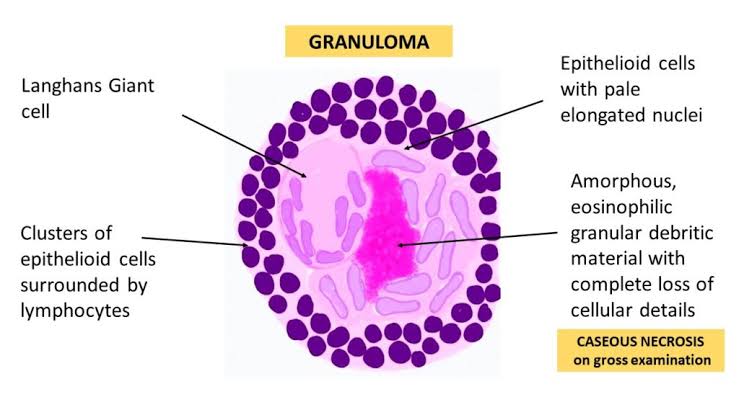 Chronic Inflammation