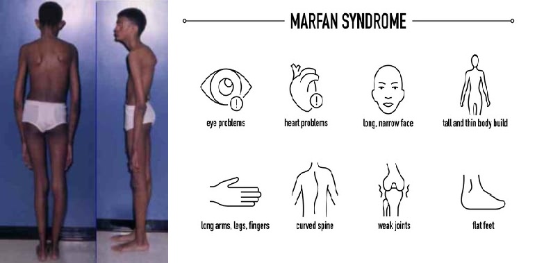 Clinical Manifestations of Marfan Syndrome