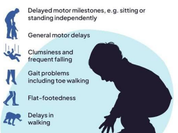 Clinical Stigmata and Gowers Sign in Duchenne Muscular Dystrophy