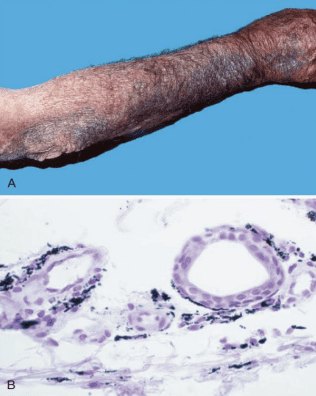 Clinical photograph and photomicrograph demonstrating cutaneous minocycline pigment deposition in dermis