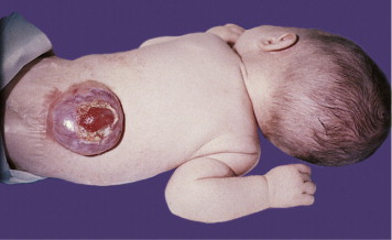 Clinical photograph of newborn with rachischisis