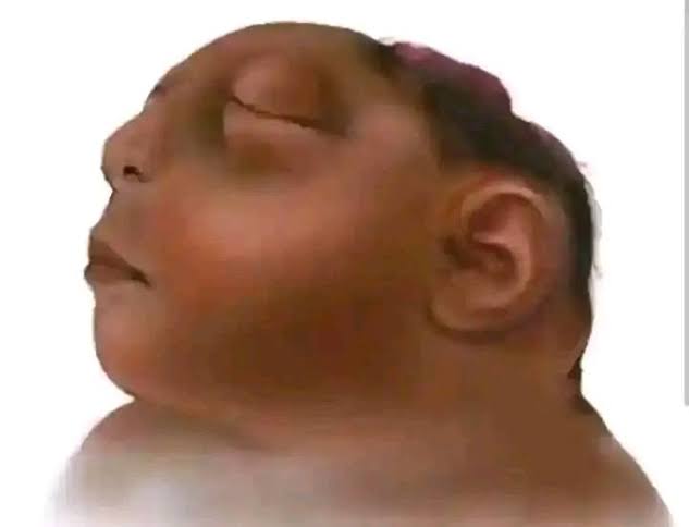 Clinical photograph of anencephaly